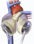 Syncardia heart
